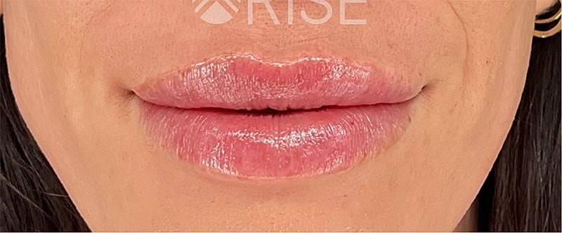 Filler Dissolving Before & After