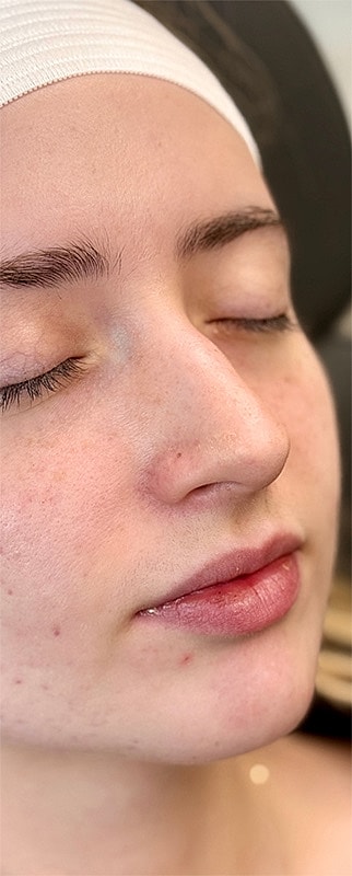 Chin Filler Before & After