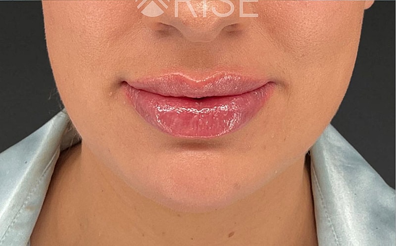 Chin Filler Before & After