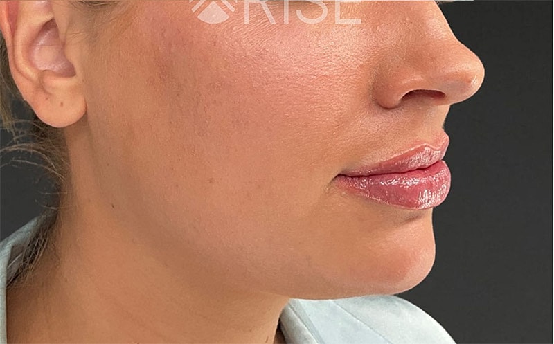 Chin Filler Before & After