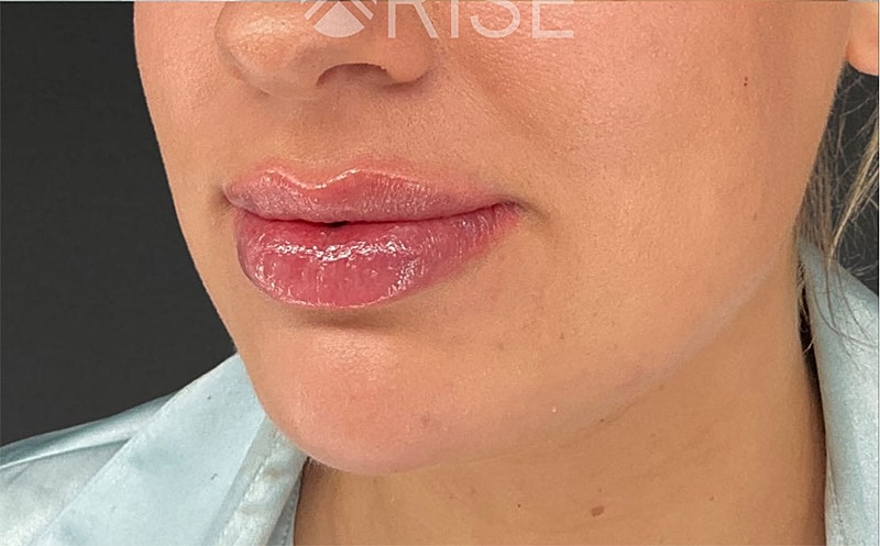 Chin Filler Before & After