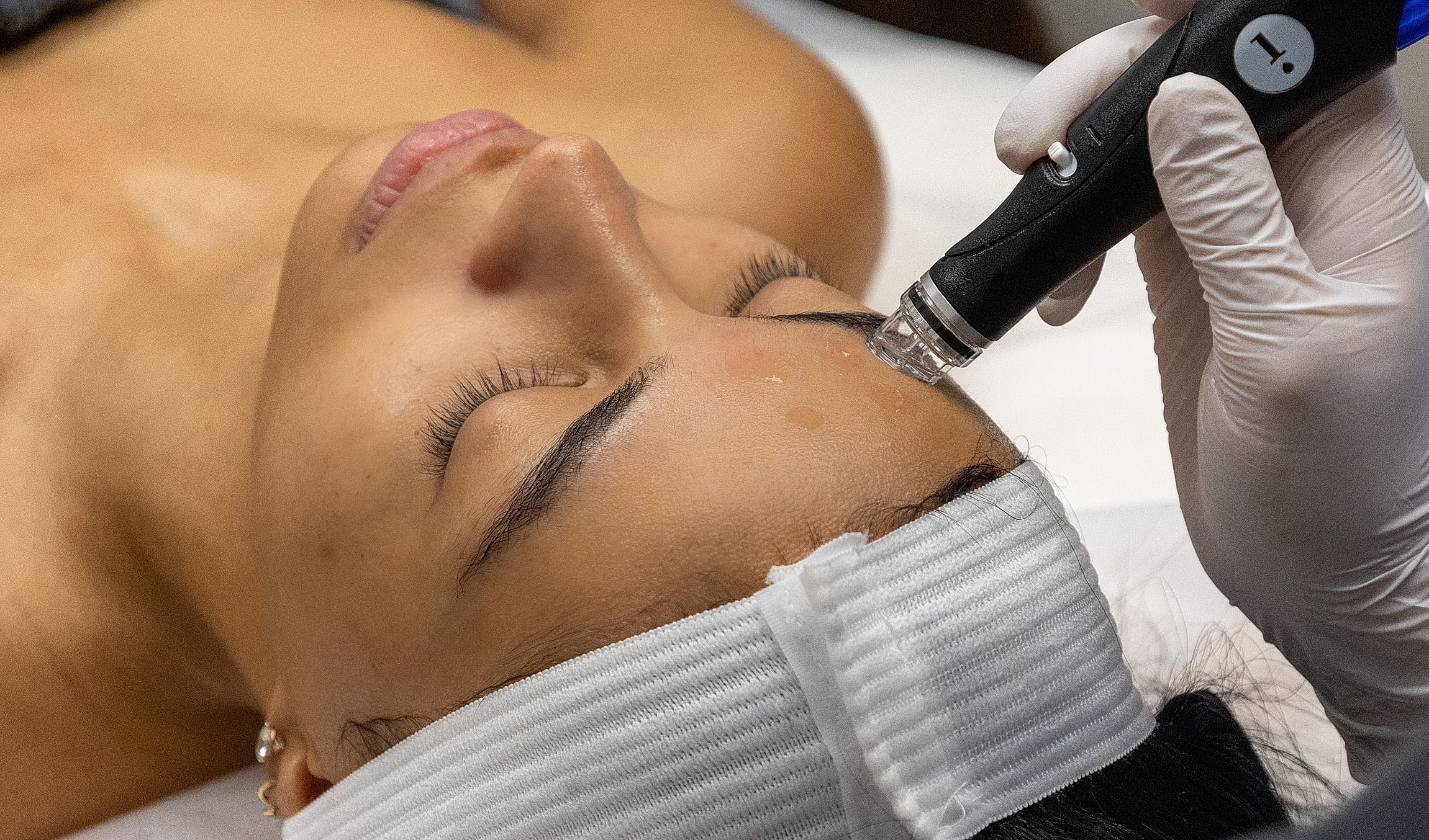 Microneedling treatment on a woman's forehead.