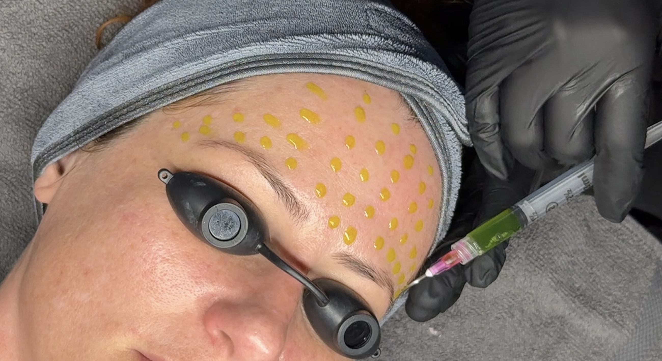 Client receiving facial treatment with micro-needling.